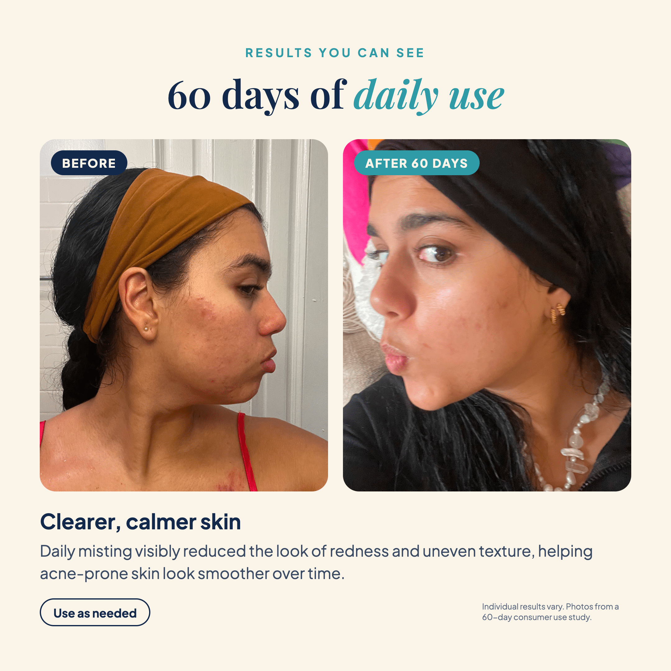Skin Repair Mist results for acne, redness and dullness